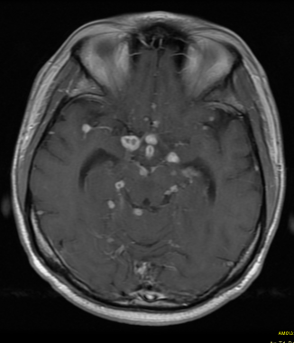 Axial T1-weighted contrast-enhanced MR shows multi