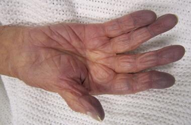 Cyanosis. Cyanosis of the hand in someone with low