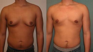 Adolescent gynecomastia. 