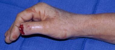 When the thumb tip has been amputated, replantatio