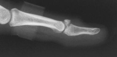 Stable mallet fracture involving 40% of joint surf