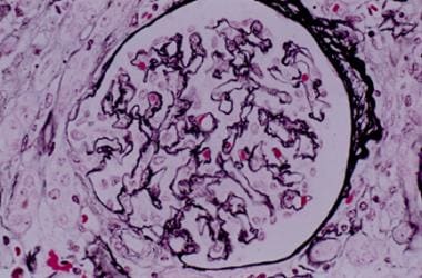 Nephrosclerosis. Glomerulus with wrinkling of glom