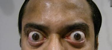 Exophthalmos due to thyroid dysfunction. The patie