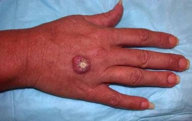 Benign Skin Lesions: Overview of Benign Skin Lesions ...