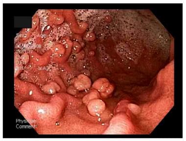 Peutz-Jeghers Syndrome. This upper endoscopy image