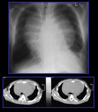 Posteroanterior chest radiograph and nonenhanced C