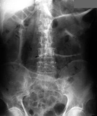 Characteristic appearance of small-bowel carcinoid