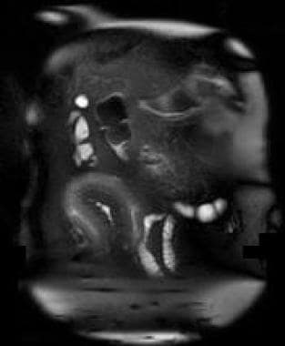MRI enterography with coronal fat-saturated T2-wei