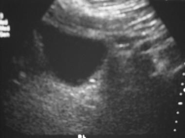 Ureterovesical junction calculus seen on abdominal