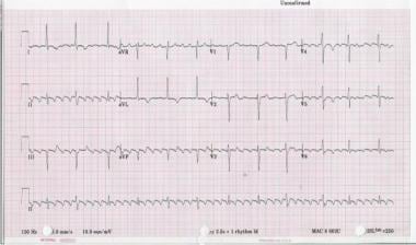 Twelve-lead ECG of type I atrial flutter. Note neg