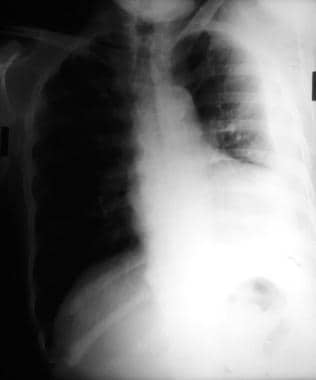 Emergent Management of Pleural Effusion. Left late