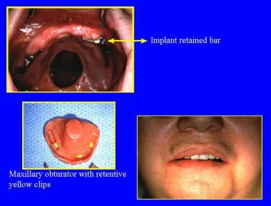 A defect in the medial portion of the hard palate 