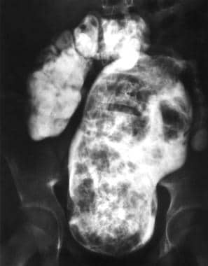 Contrast enema of a patient with megasigmoid and i