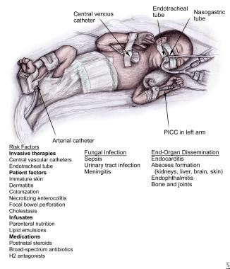 Fungal Infections in Preterm Infants. Risk factors