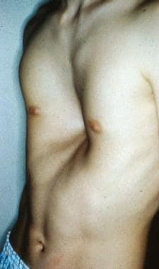 A 16-year-old boy with severe pectus excavatum. No