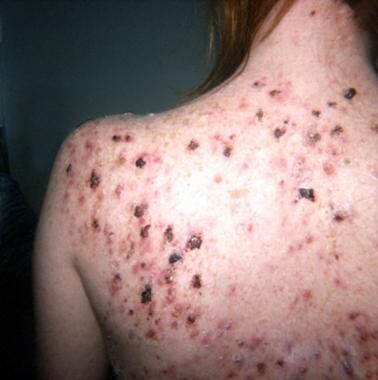 Nodules and pustules on the back. Courtesy of Eman