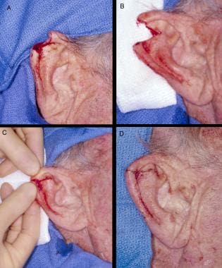 Wedge excision repair. Panel A: Defect after cance