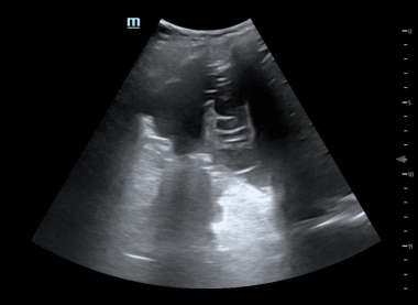 Emergent Management of Pleural Effusion. Right lat