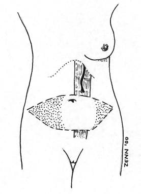 Blood supply to the unipedicled transverse rectus 