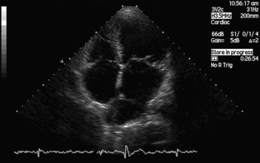 Cor Triatriatum. Echocardiogram showing the proxim