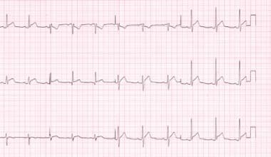 Stage 1 electrocardiograph changes in a patient wi