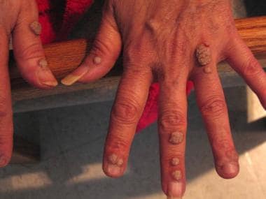 Verrucous warts in patient with HIV infection. 