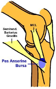Location of pes anserinus bursa on medial knee. MC