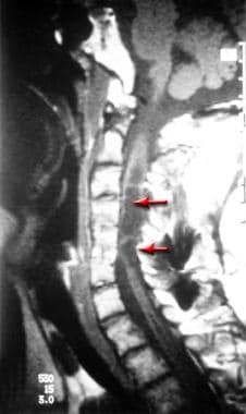 This illustration shows a T1-weighted, cervical ma