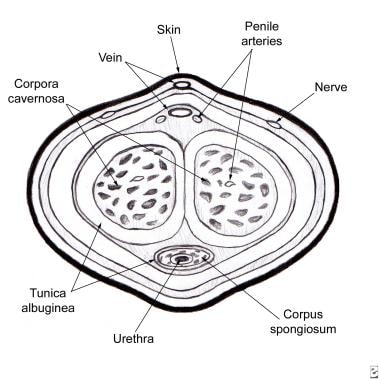 Urethral strictures. Cross-sectional diagram of th