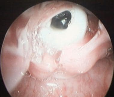 A glottic endoscopic view of the top of Aboulker s