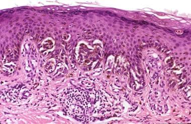 Pathology of Spitz nevi. Pigmented spindle cell ne