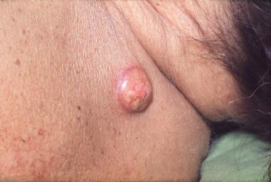 Lung cancer, skin metastasis. Photograph shows a s