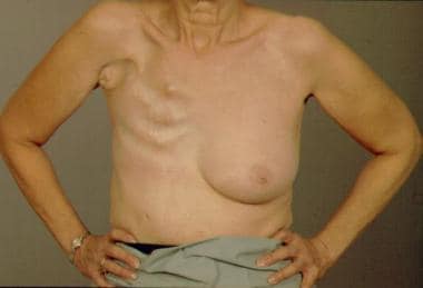 Radical mastectomy defect. 