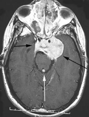 Axial postcontrast T1-weighted image shows a large