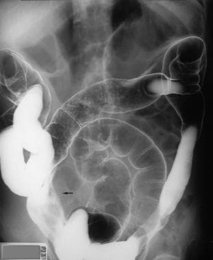 Characteristic appearance of small bowel carcinoid