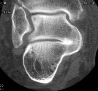 Talocalcaneal coalition. CT scan. Note the fusion 