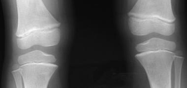 Radiograph in a 4-year-old girl with rickets, focu