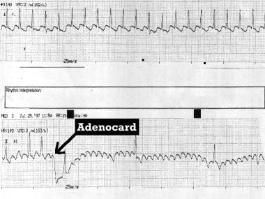 Type I atrial flutter unmasked by adenosine (Adeno