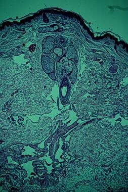 Overview of a histologic section from a tumor depi