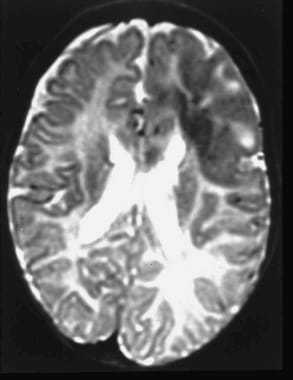 The child whose CT scan is shown presented with me