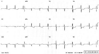 Electrocardiogram of a patient presenting to the E