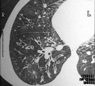 Varicose bronchiectasis with alternating areas of 