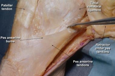 Pes anserinus bursa is located on proximomedial as