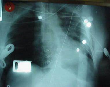 Chest radiograph shows two abnormalities: (1) tens