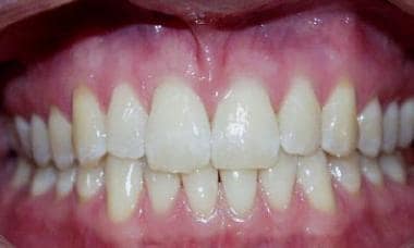 Healthy mouth and gingiva. Note the healthy light 