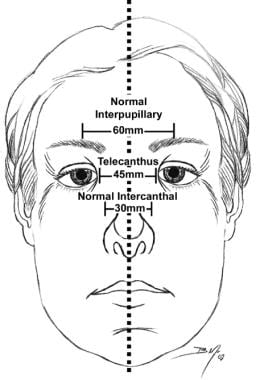 Midface dimensions are depicted. A normal intercan