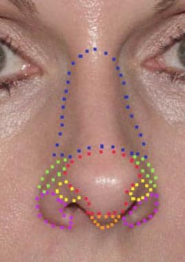 Aesthetic subunits of the nose: Nasal dorsum (blue