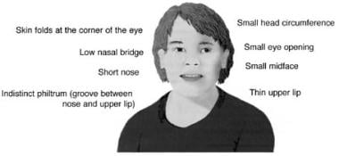 Fetal Alcohol Syndrome. Facial characteristics of 