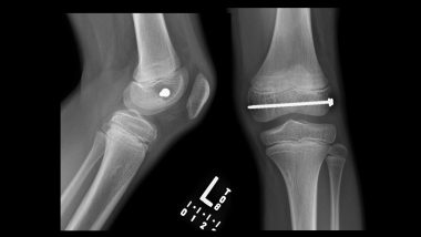 Growth plate (physeal) fractures. Healed Salter-H