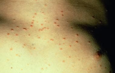 Guttate psoriasis. The distinctive, acute clinical